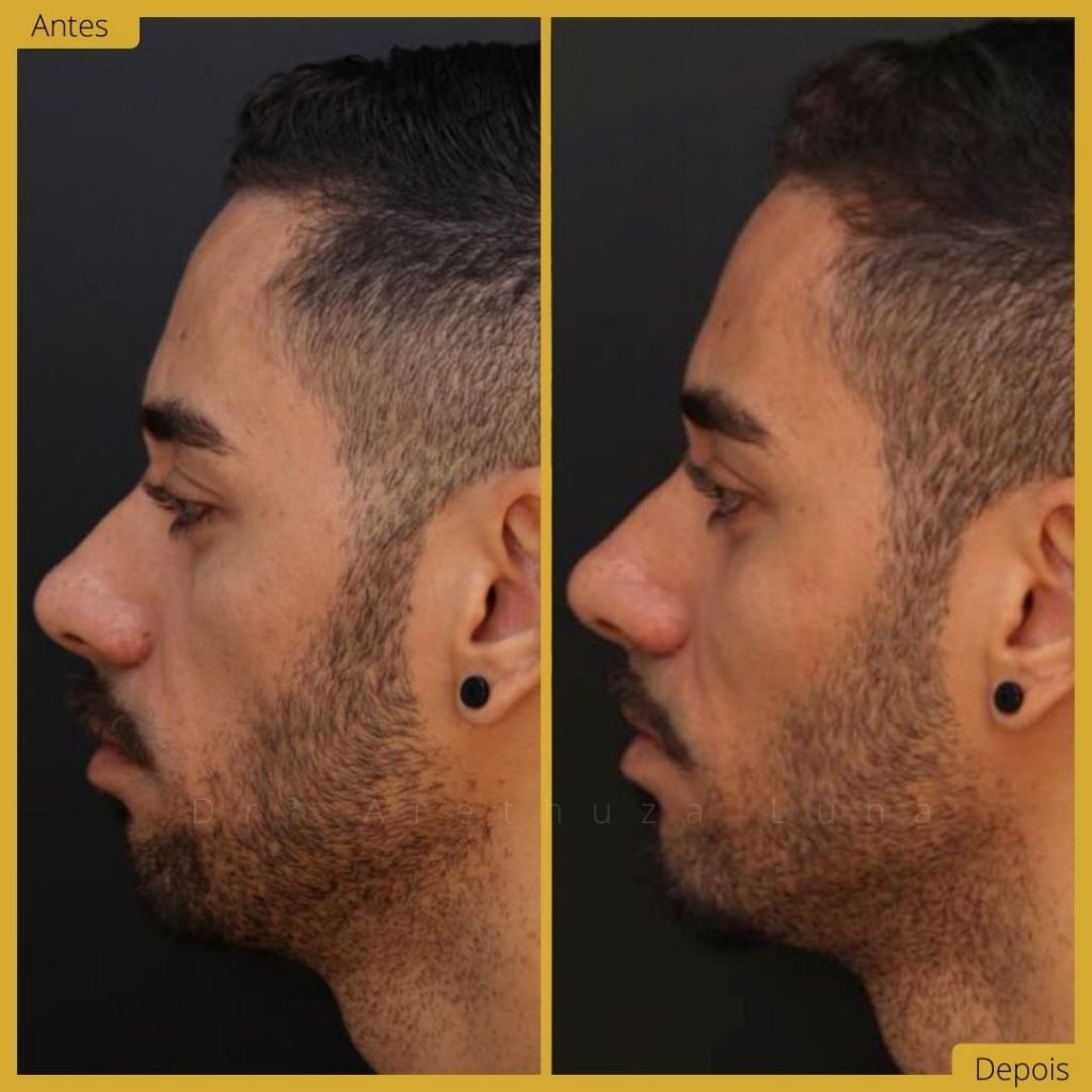 Preenchimento do Malar - Caso 1