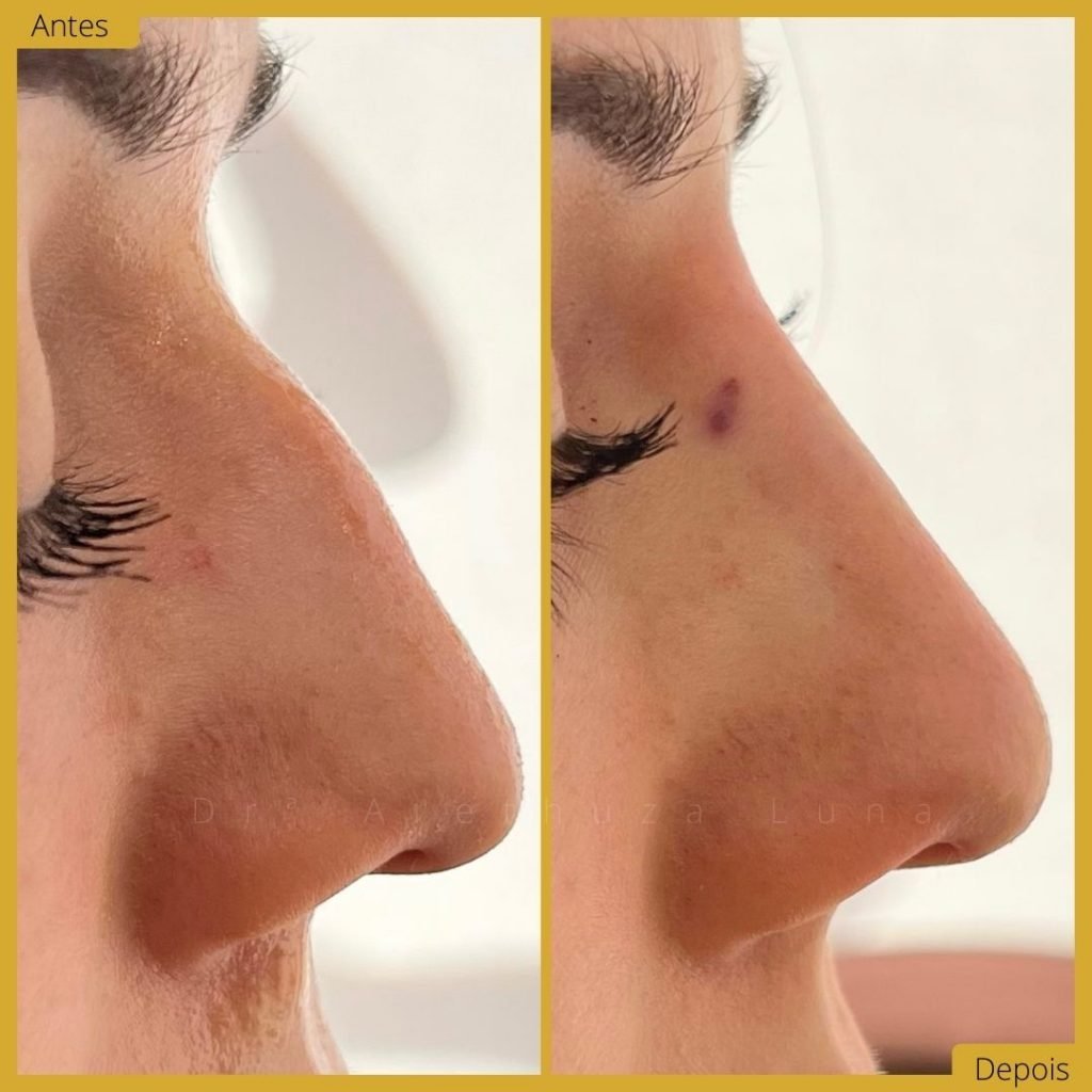 Rinomodelação - Caso 1