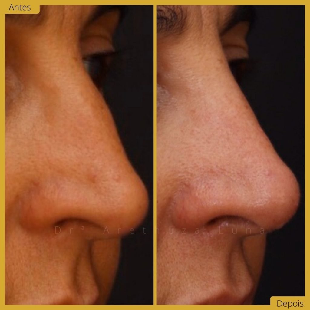 Rinomodelação - Caso 2