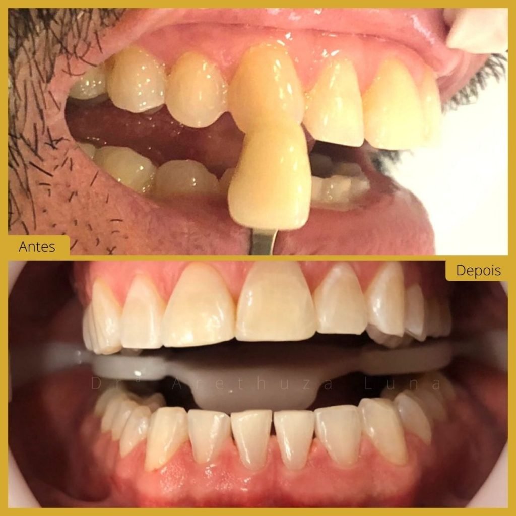 Branqueamento Dentário - Caso 1