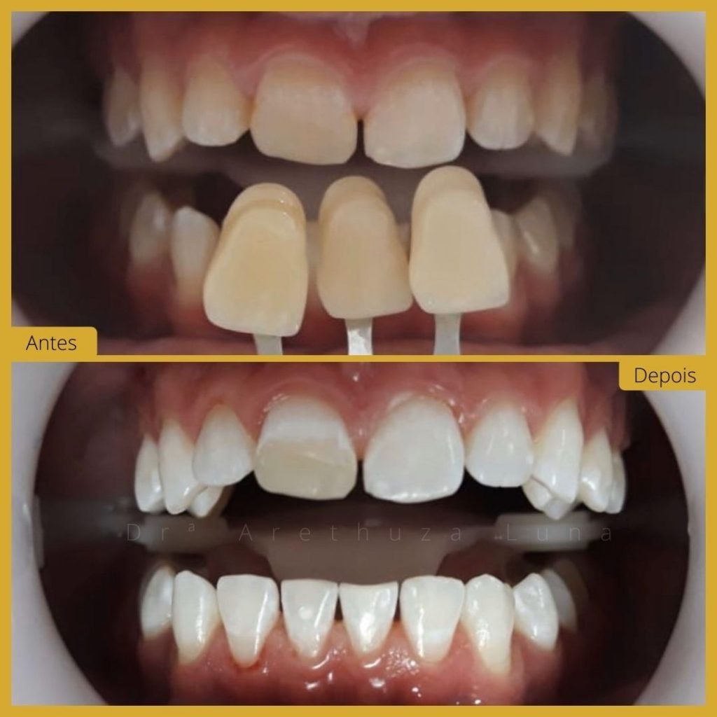 Branqueamento Dentário - Caso 2