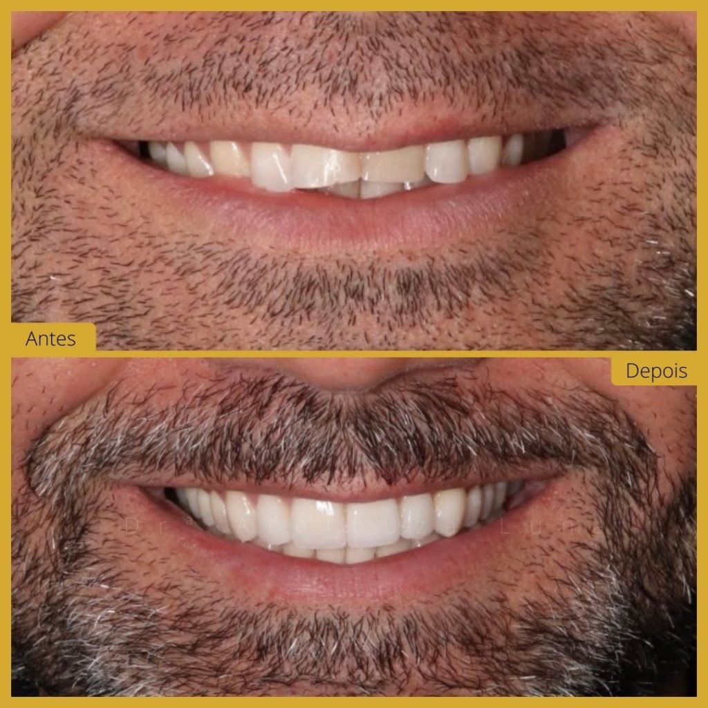 facetas dentárias