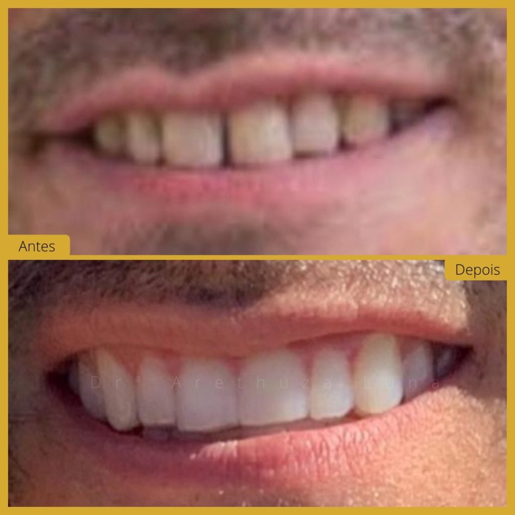 Alinhadores Invisíveis – Caso 1