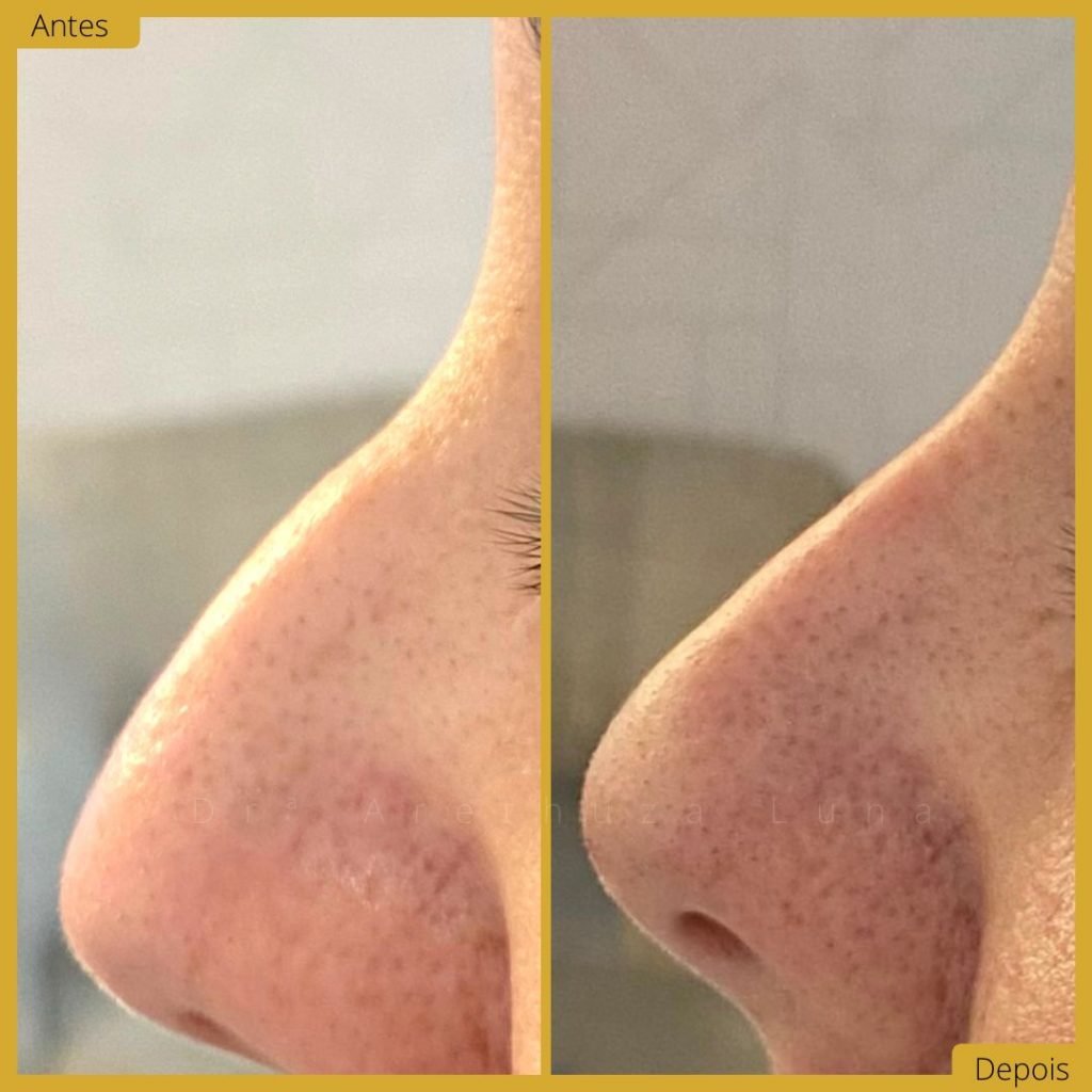 Ácido hialurónico – Caso 5