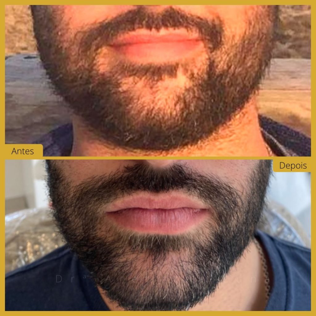 Bichectomia - Caso 2