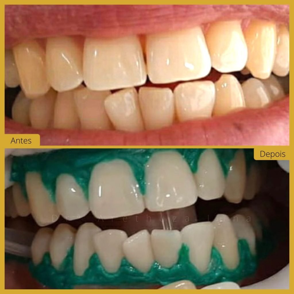 Branqueamento Dentário - Caso 4