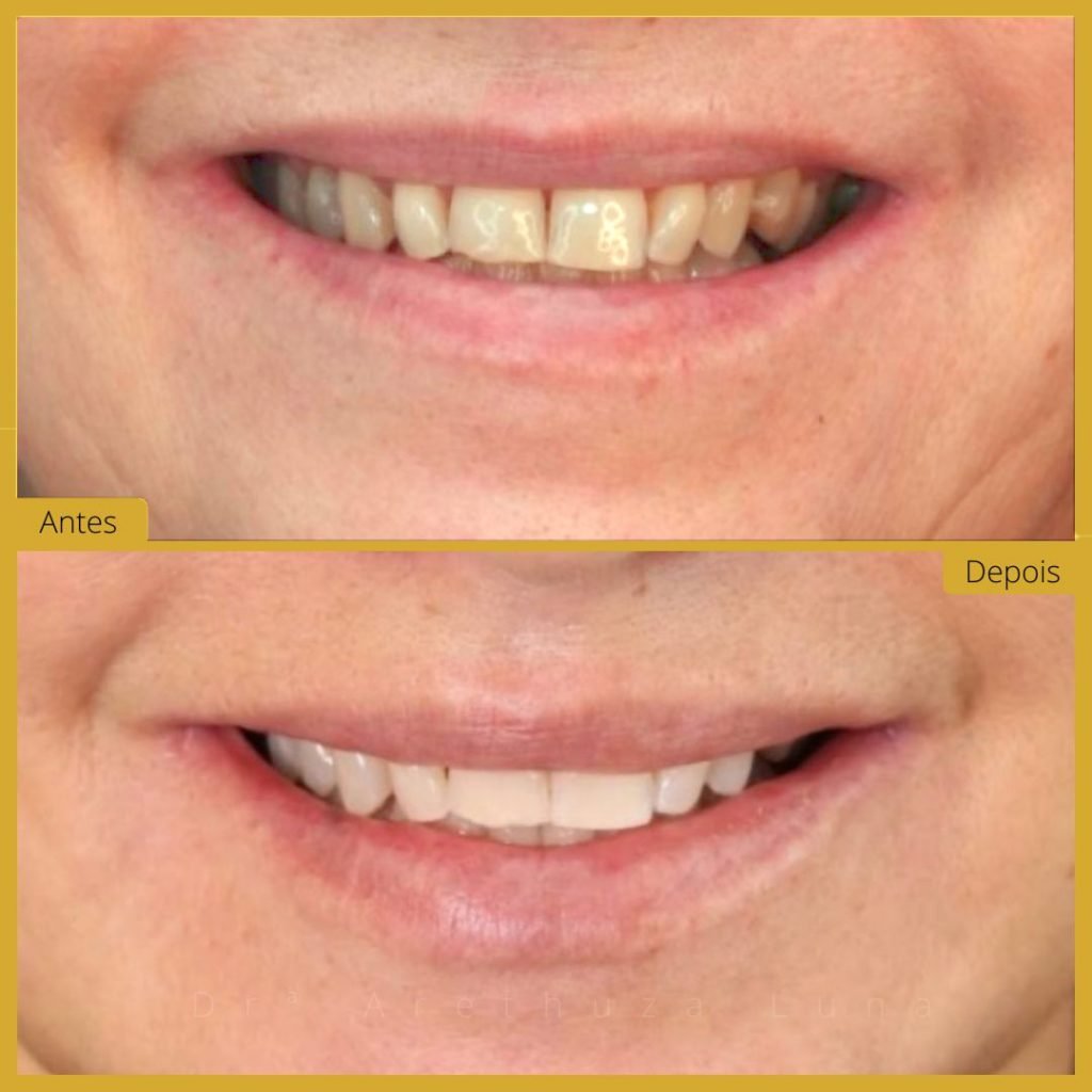 Branqueamento Dentário - Caso 6