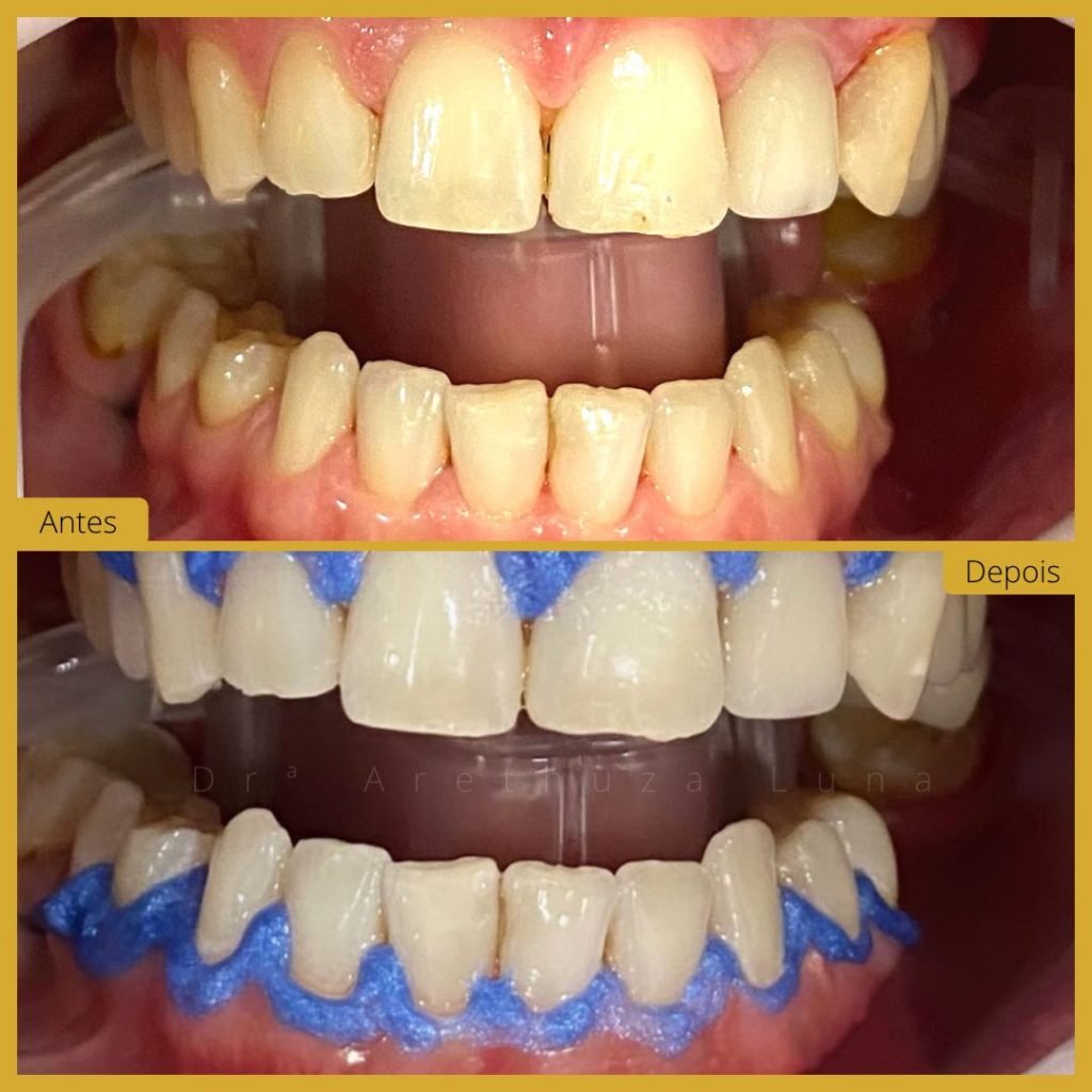 Branqueamento dentário – Caso 8