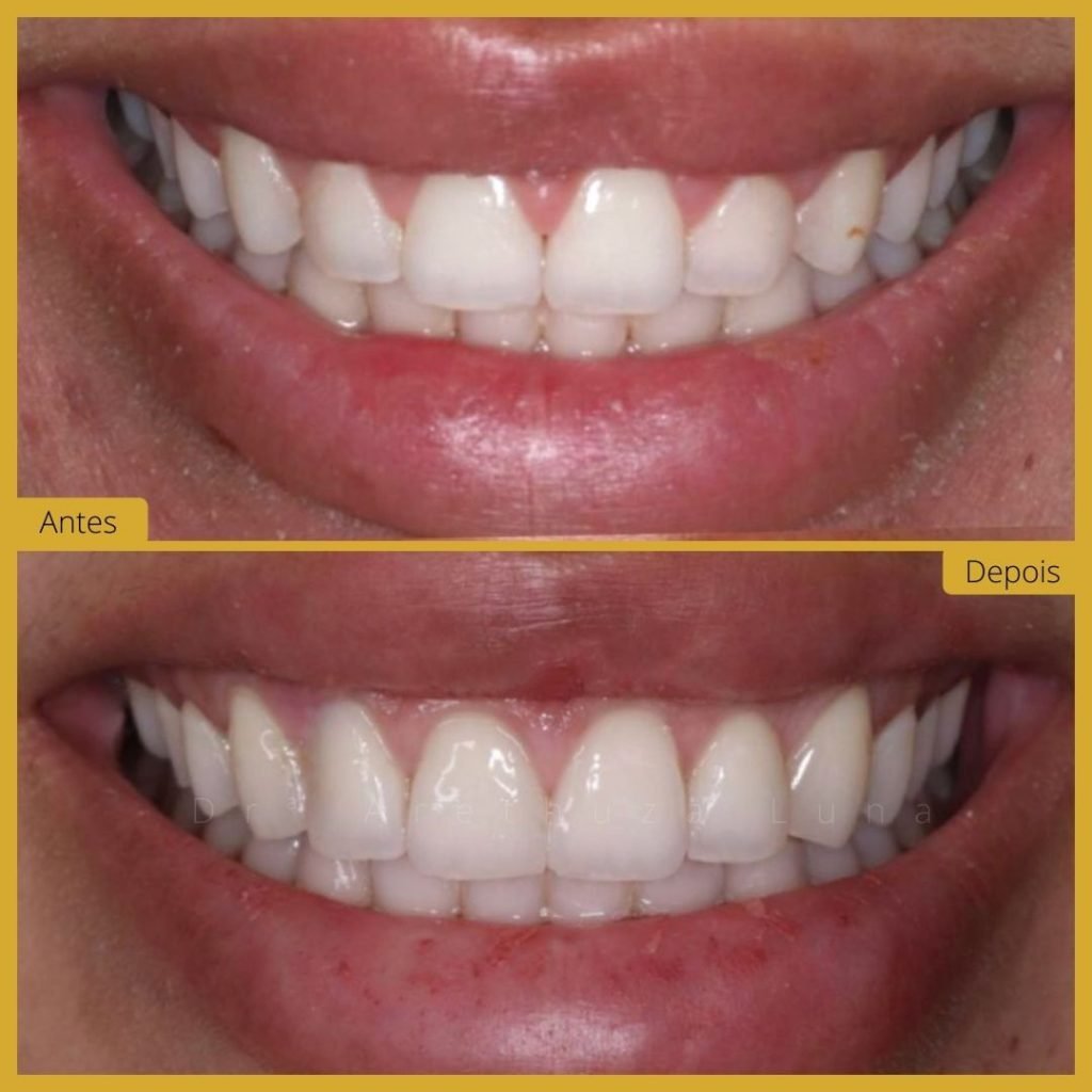 Plástica Gengival – Caso 1