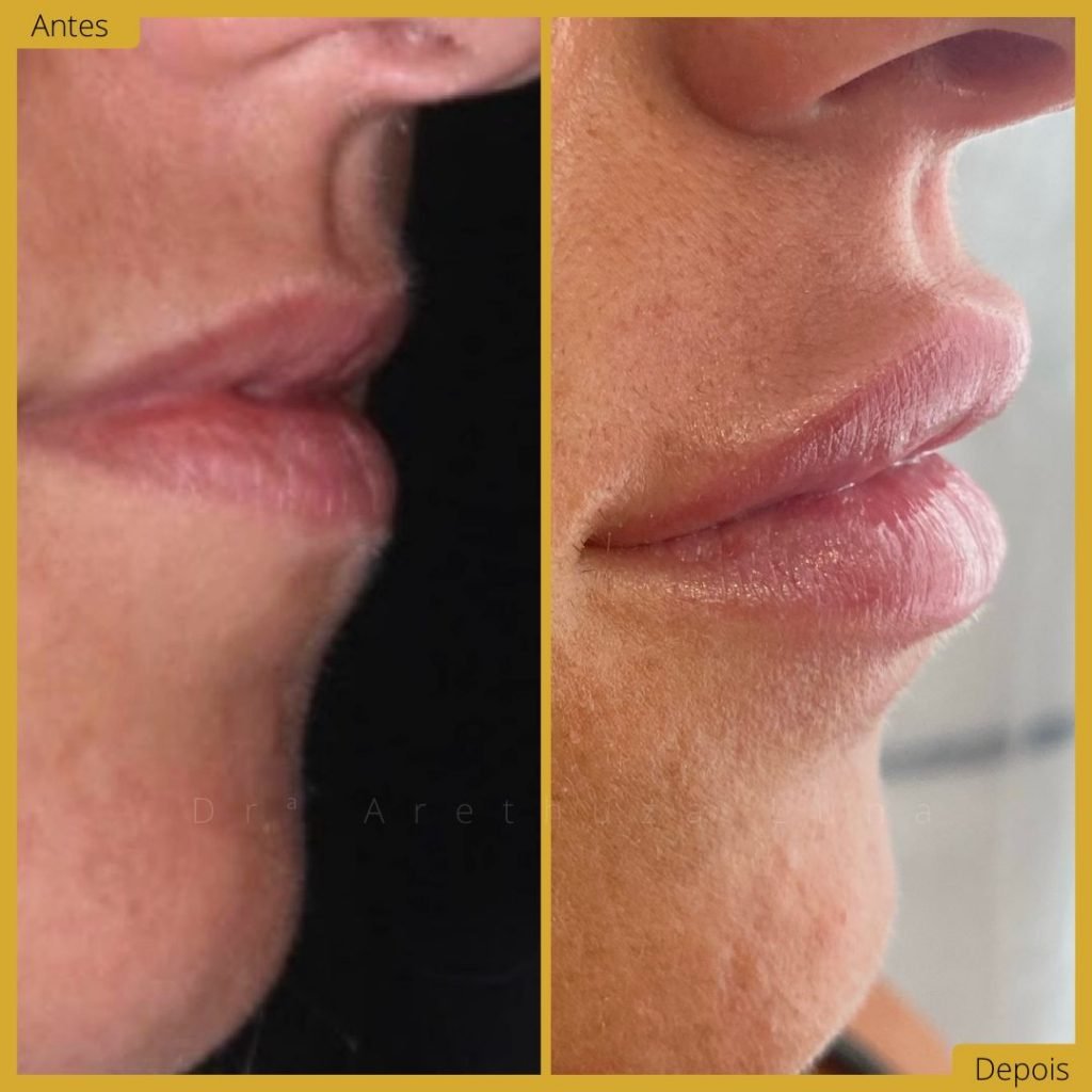 Preenchimento labial - Caso 9