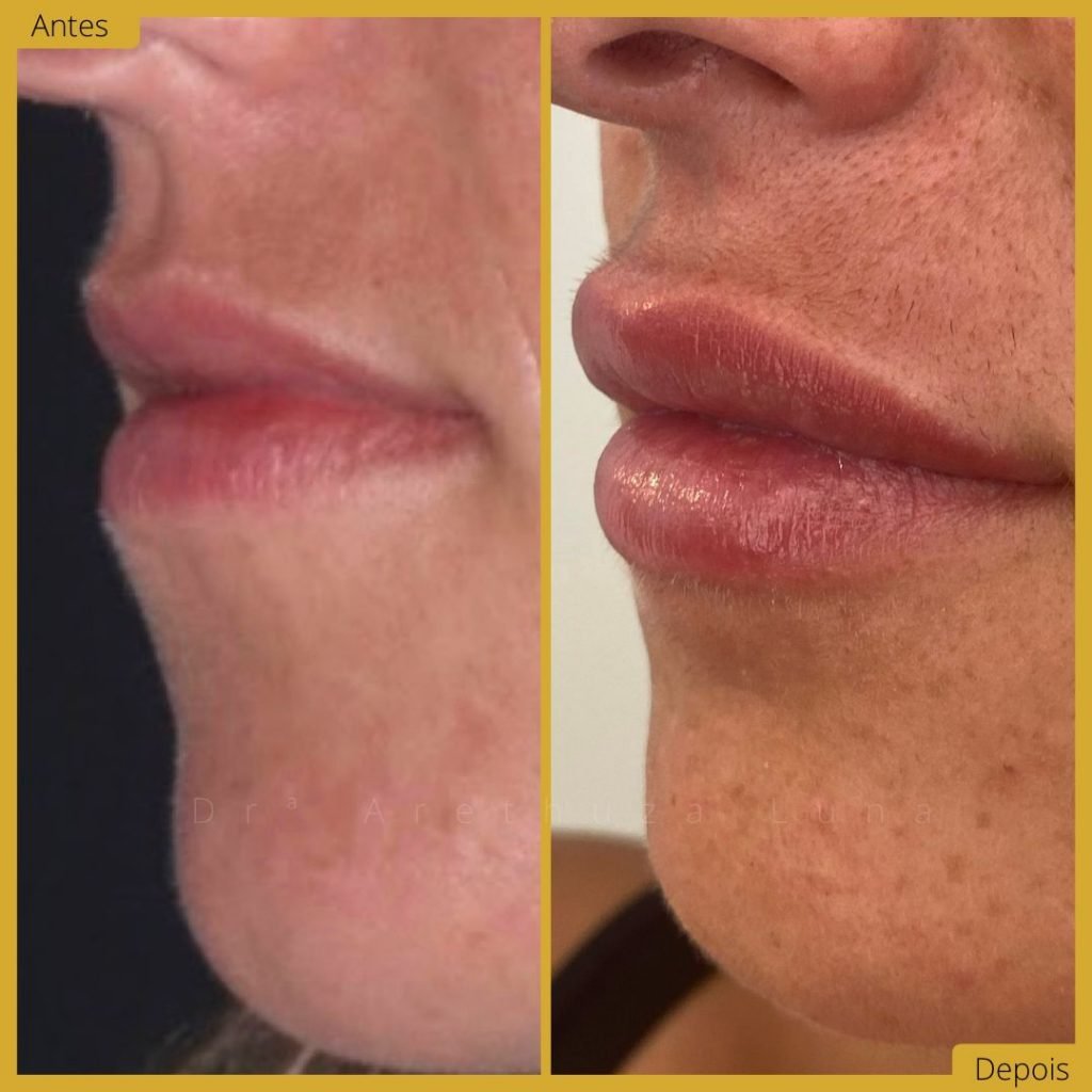 Preenchimento labial - Caso 9