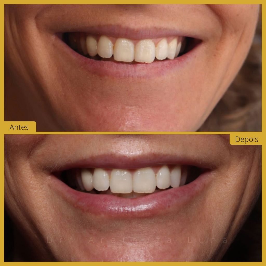 Preenchimento labial - Caso 2