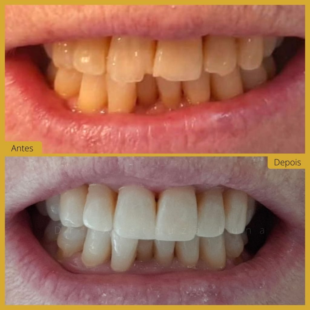 Branqueamento e Resina - Caso 1