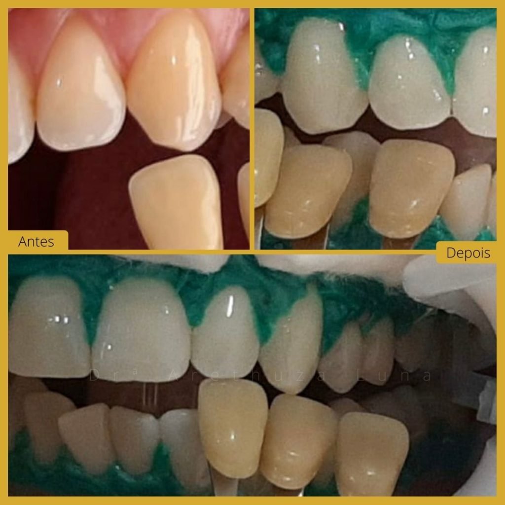 Branqueamento Dentário - Caso 4