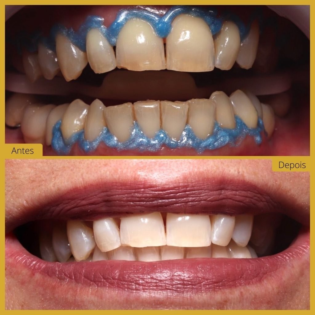 Branqueamento Dentário - Caso 6
