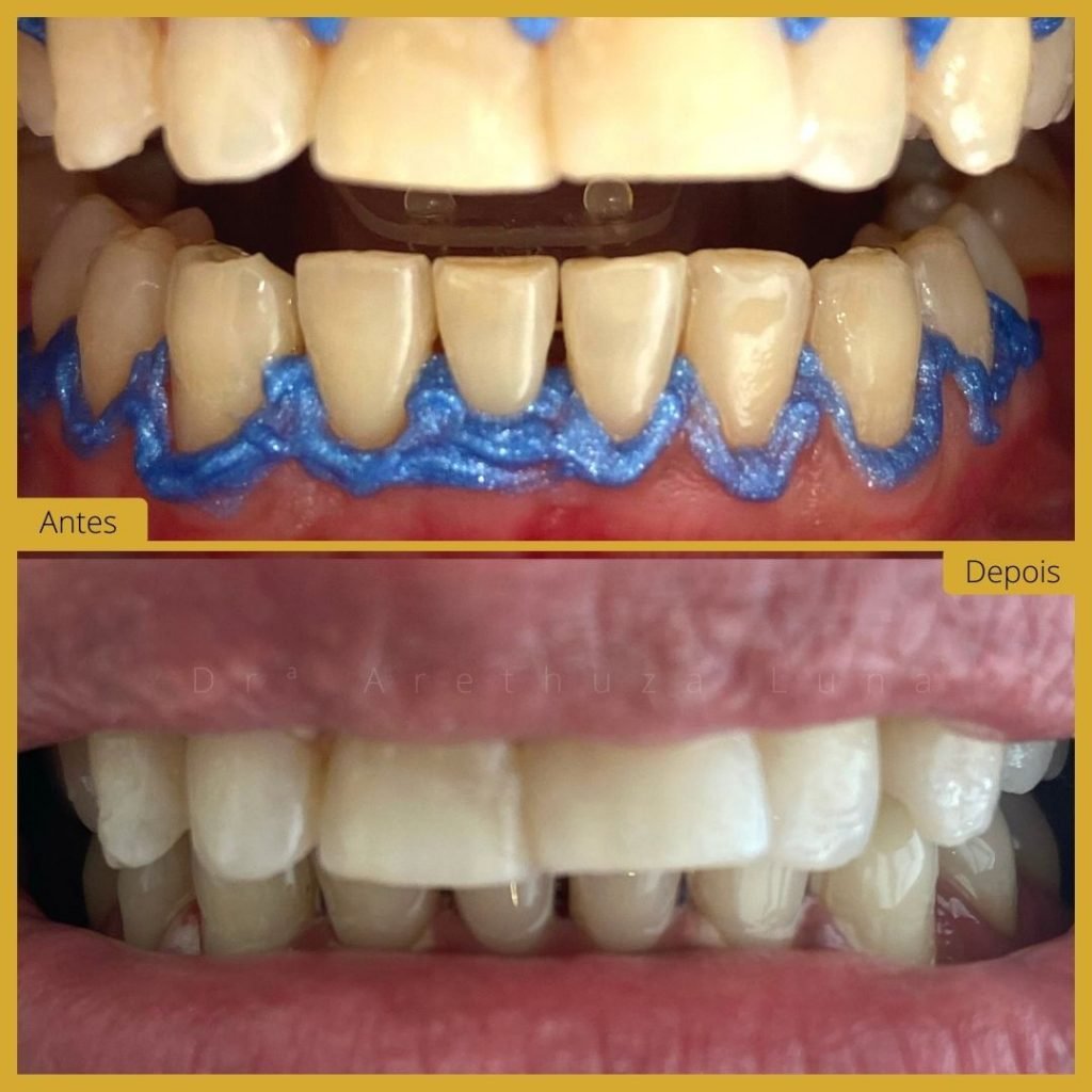 Branqueamento Dentário - Caso 7