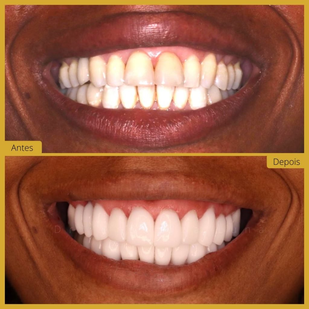 Facetas Dentárias – Caso 3