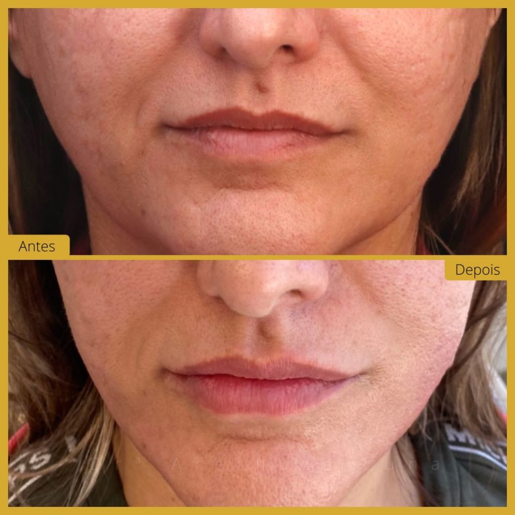 Fios Tensores - Caso 1