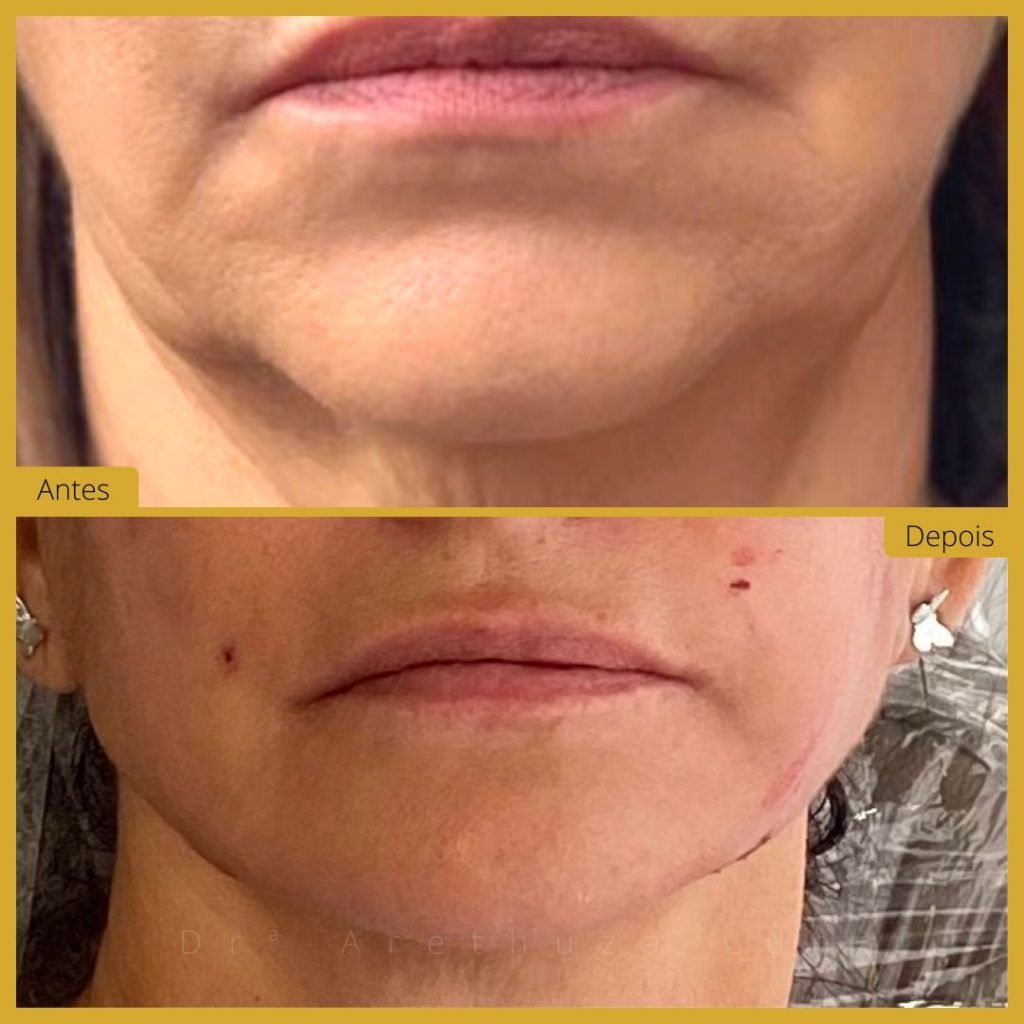 Harmonização Facial - Caso 5