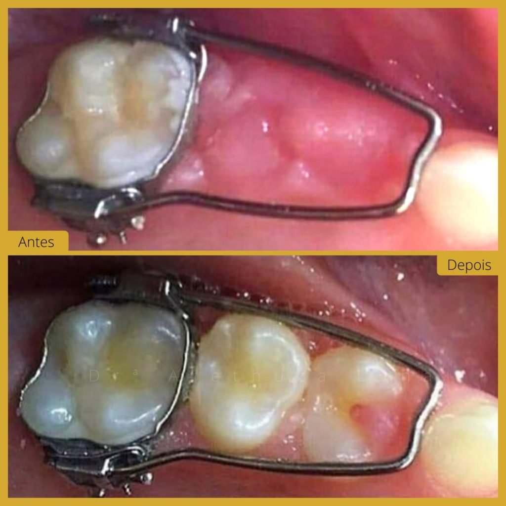 Ortopedia Facial - Caso 1