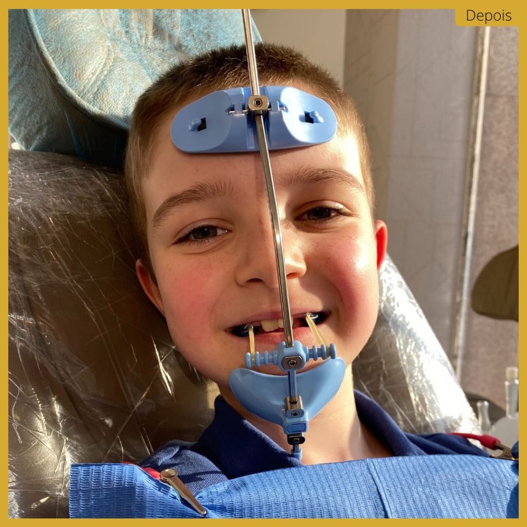 Ortopedia Facial - Caso 1