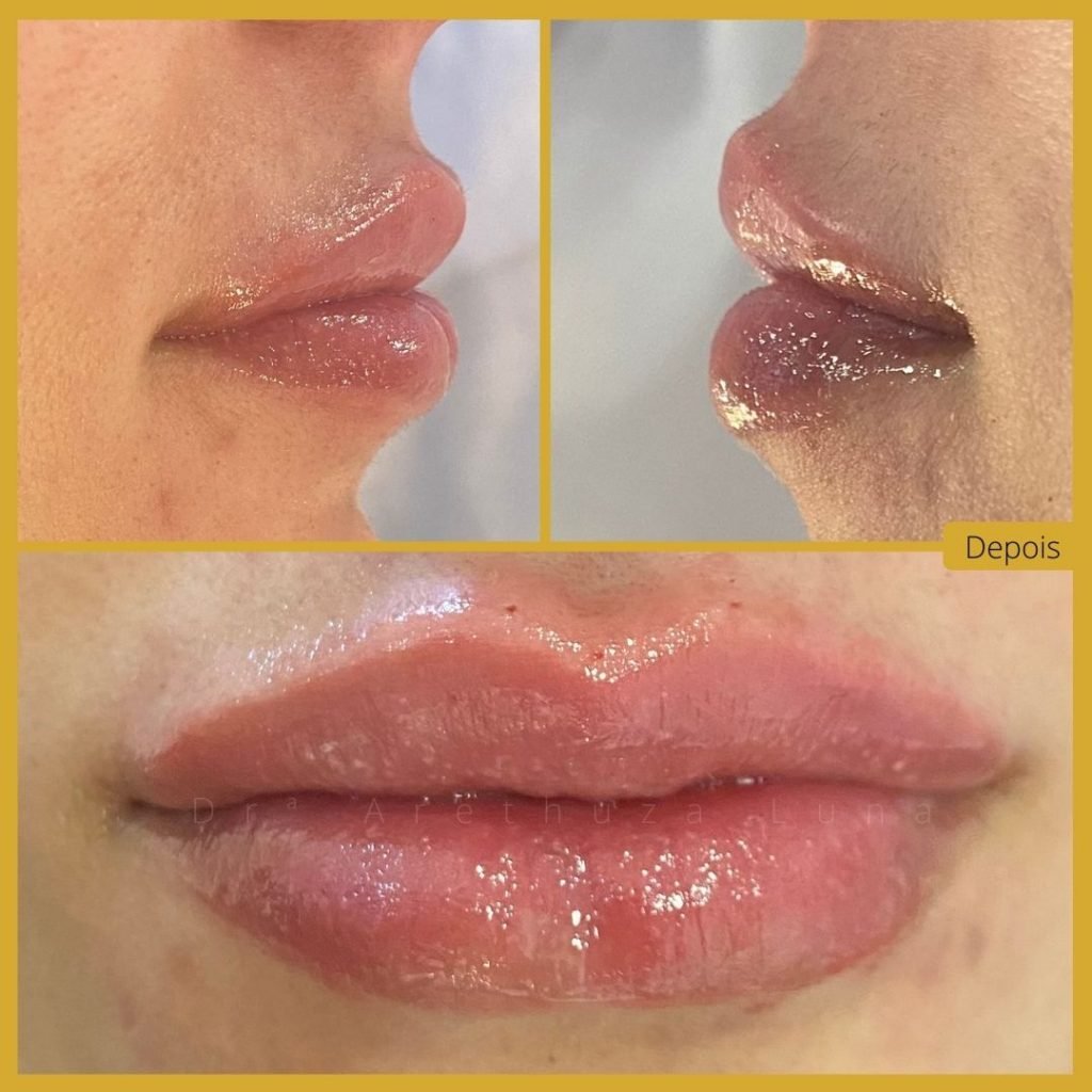 Preenchimento Labial - Caso 11
