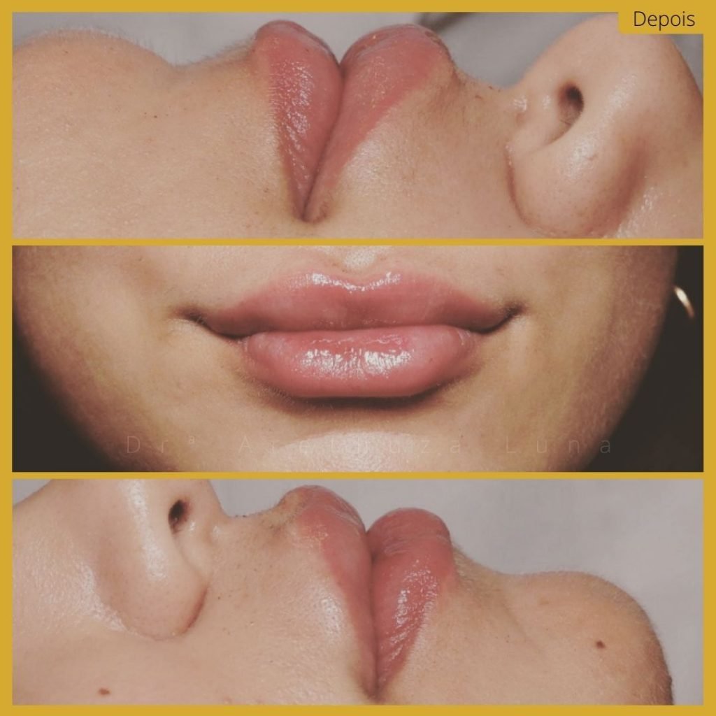 Preenchimento Labial - Caso 12