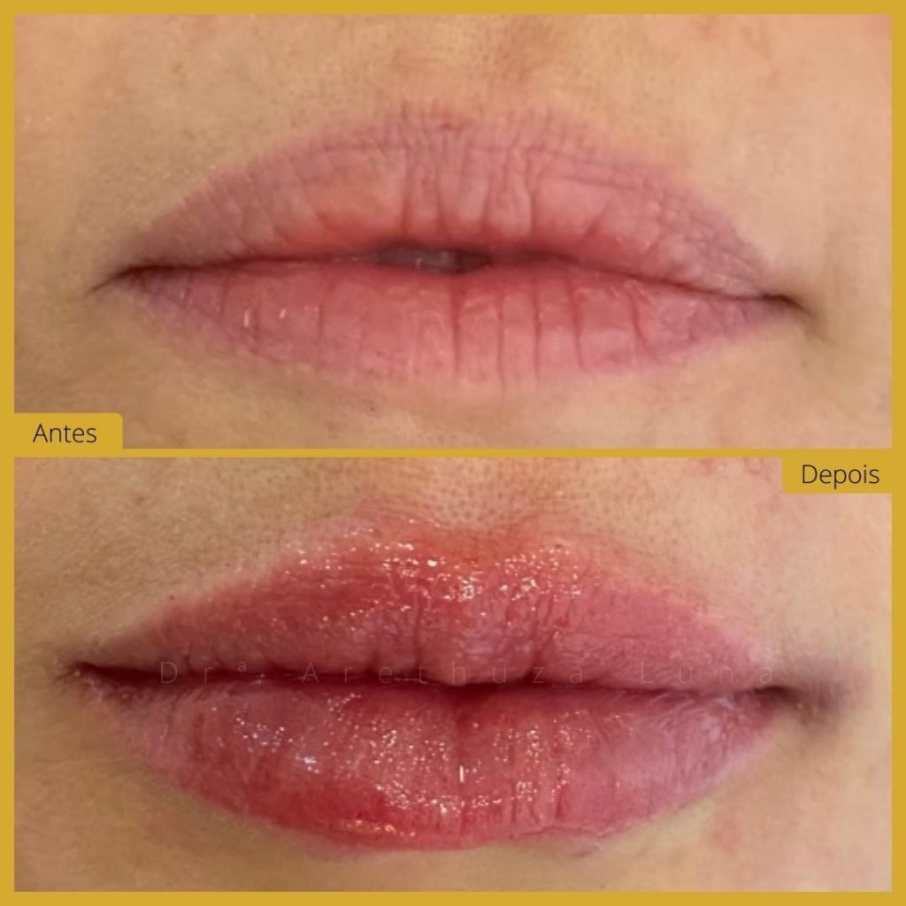 Preenchimento Labial - Caso 10