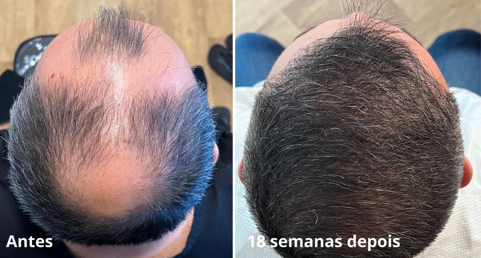 transplante capilar pós-operatório