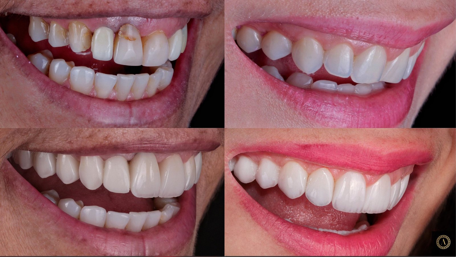 facetas dentárias areluna